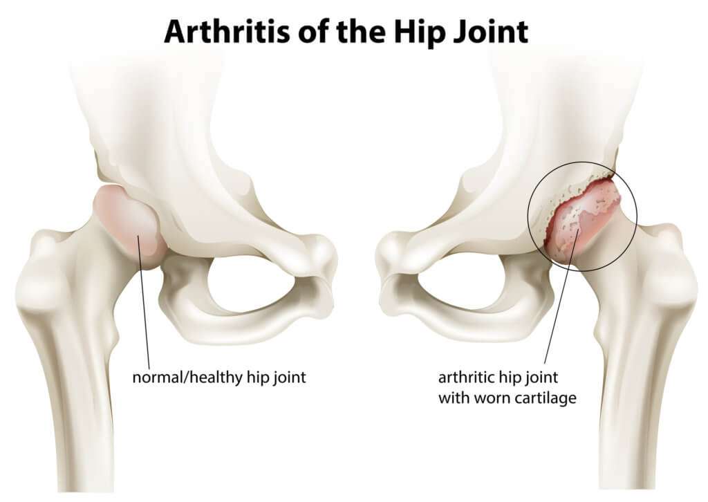Image of a human hip showing degeneration of the hip joint causing arthritis of the hip.